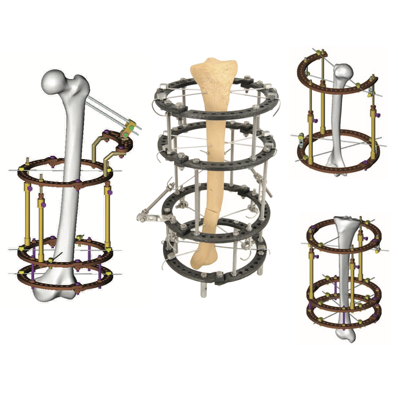 Апарати зовнішньої фіксації
